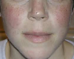 Lupus/sle Treatment in Pune