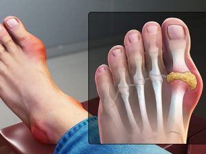 What is gout?