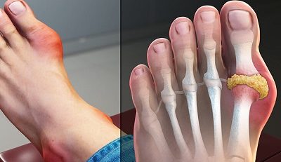 What is gout?
